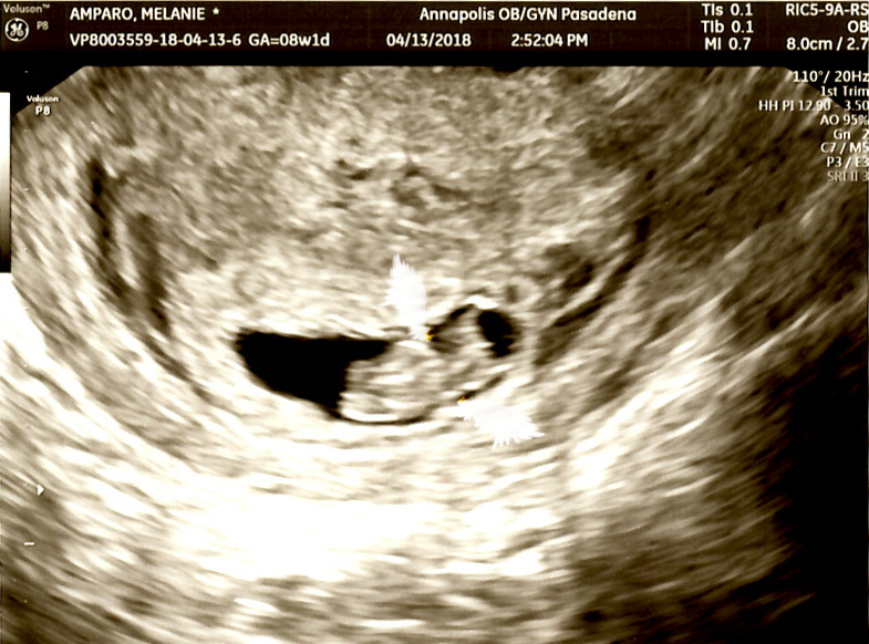 ultrasound of baby prior to miscarriage