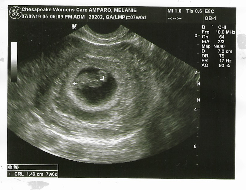 Melanie Amparo's ultrasound before miscarriage